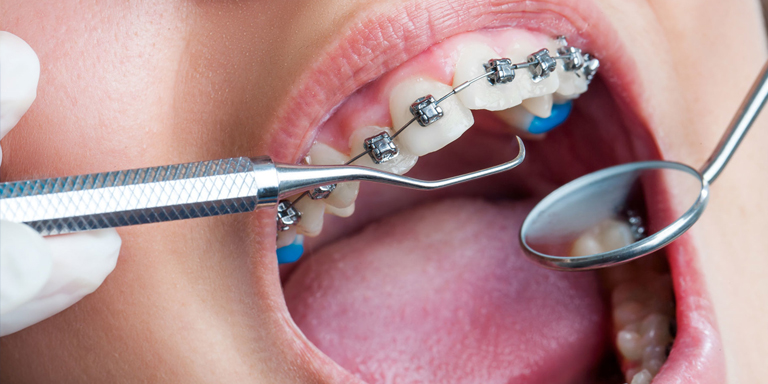 What To Know Before Getting Braces In Arlington Cosmo