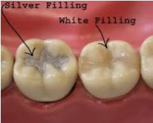 Dental Filling