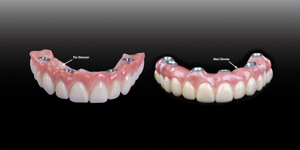 Dental Implant Surgery
