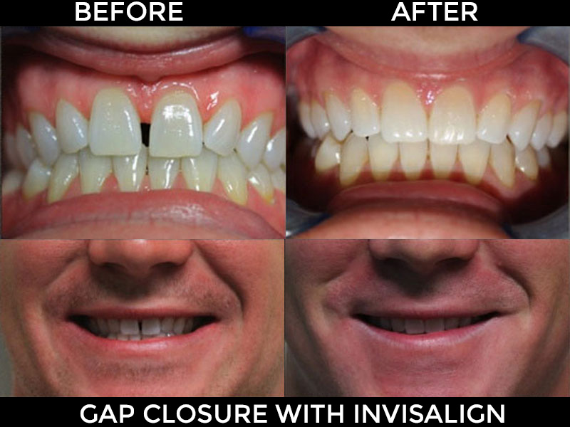 Invisalign Treatment Arlington VA