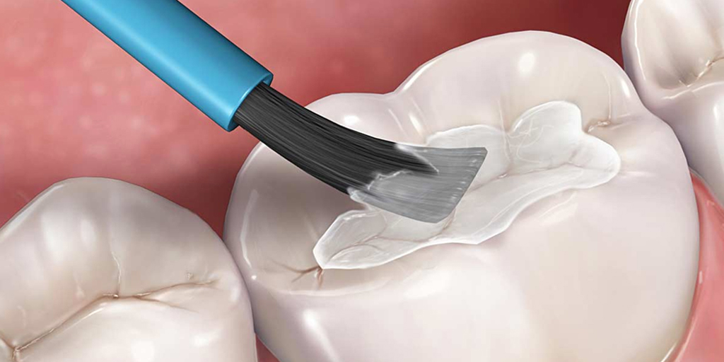 Tooth Sealants in Arlington