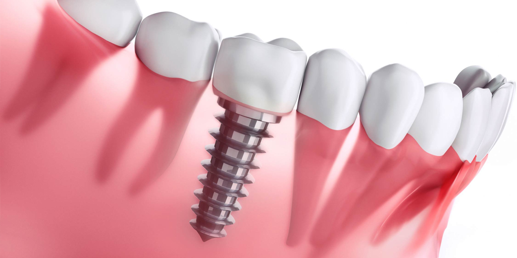 Are Dental Implants As Strong As Real Teeth