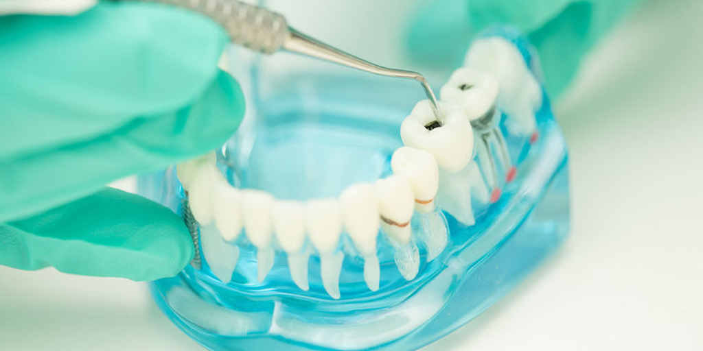Signs You Might Need Dentures
