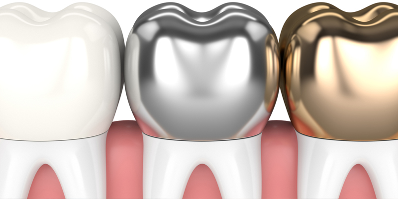 dental crowns