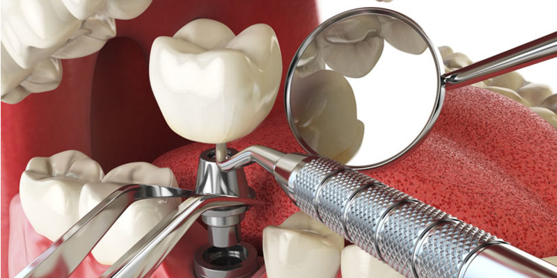 DENTAL CROWN & IMPLANTS Arlington VA