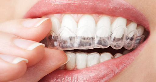 Invisalign