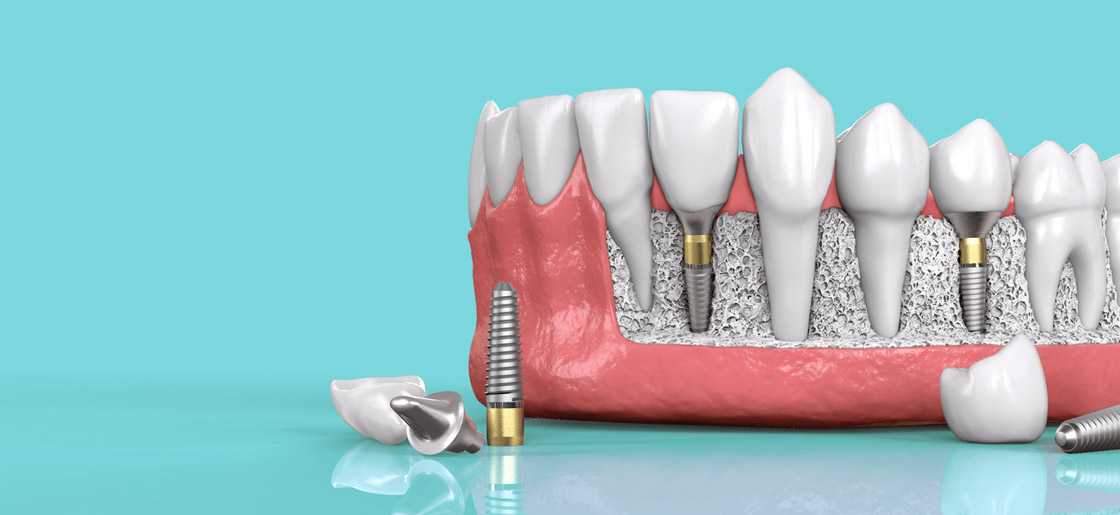 DENTAL IMPLANTS NEAR ME