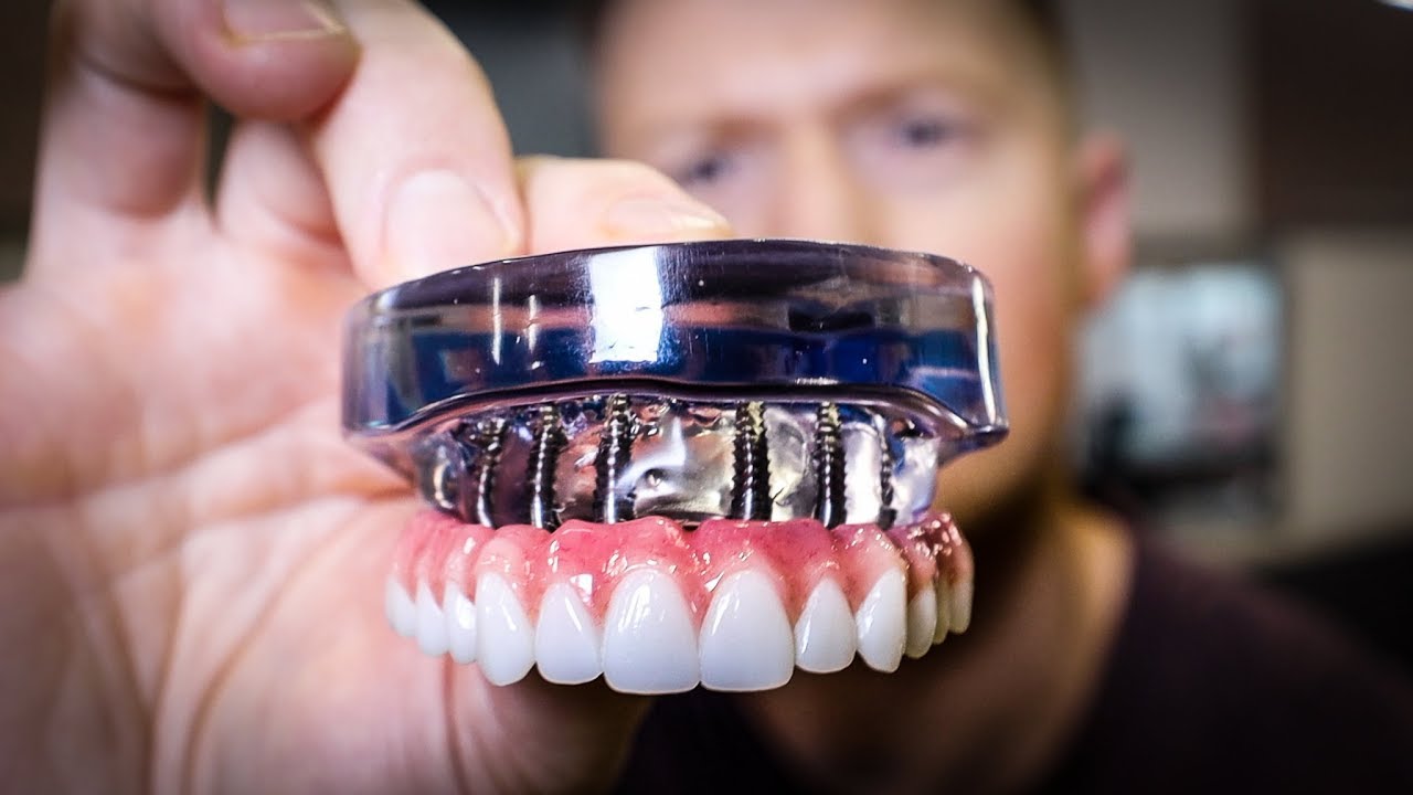 DENTAL IMPLANTS OR DENTURES