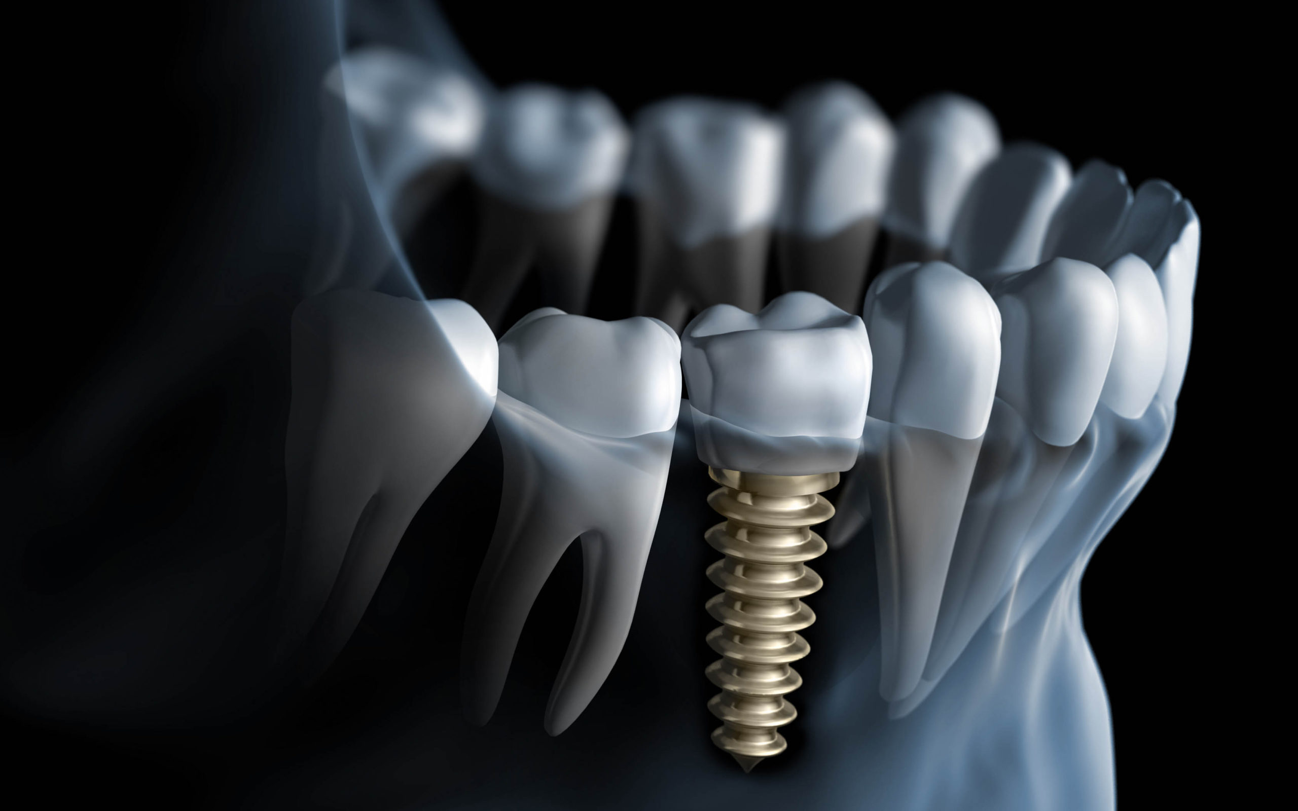 dental implant