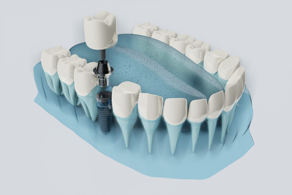 Dental Implants