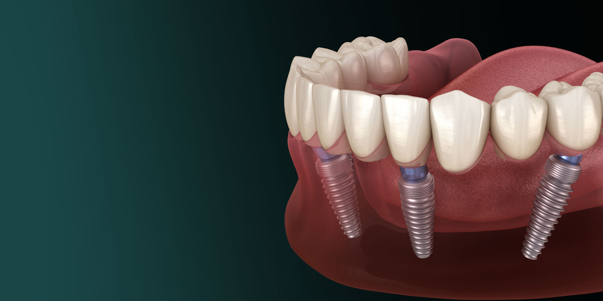 dental implant surgery