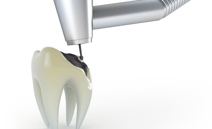 Tooth Fillings and Restorative Dentistry
