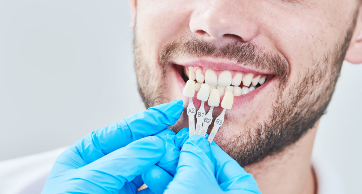 Dental Veneers
