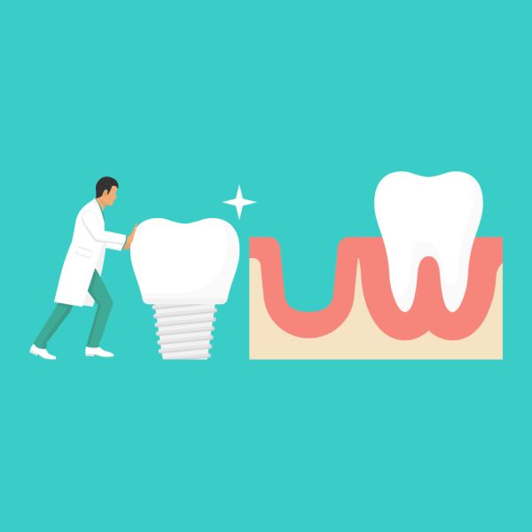 Dental Veneers