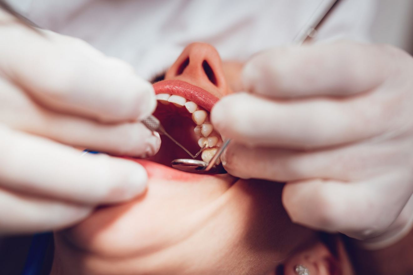 Everything you need to Know about Tooth Removal