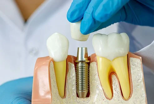 Reasons You Should Not Avoid Dental Implants