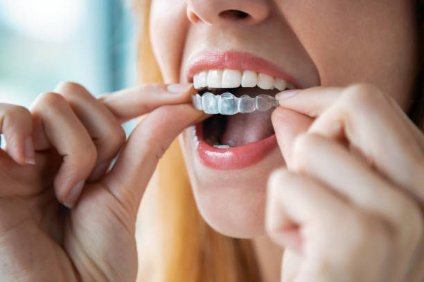 Invisalign Braces Arlington VA