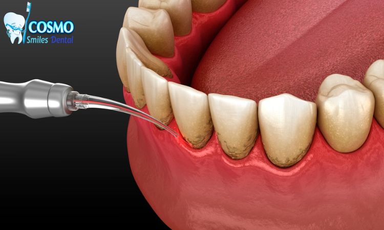 Laser Gum Surgery in Arlington