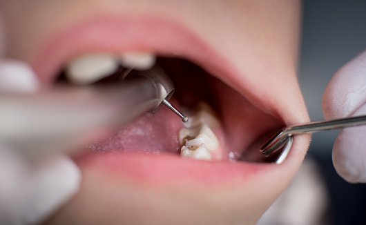 Before getting Tooth Fillings you must keep certain things at mind