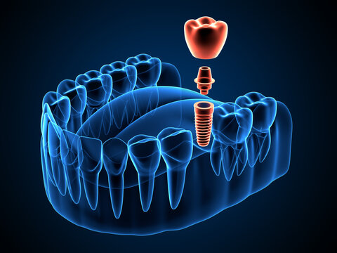 Dental implants are the top most reliable and lasting ways