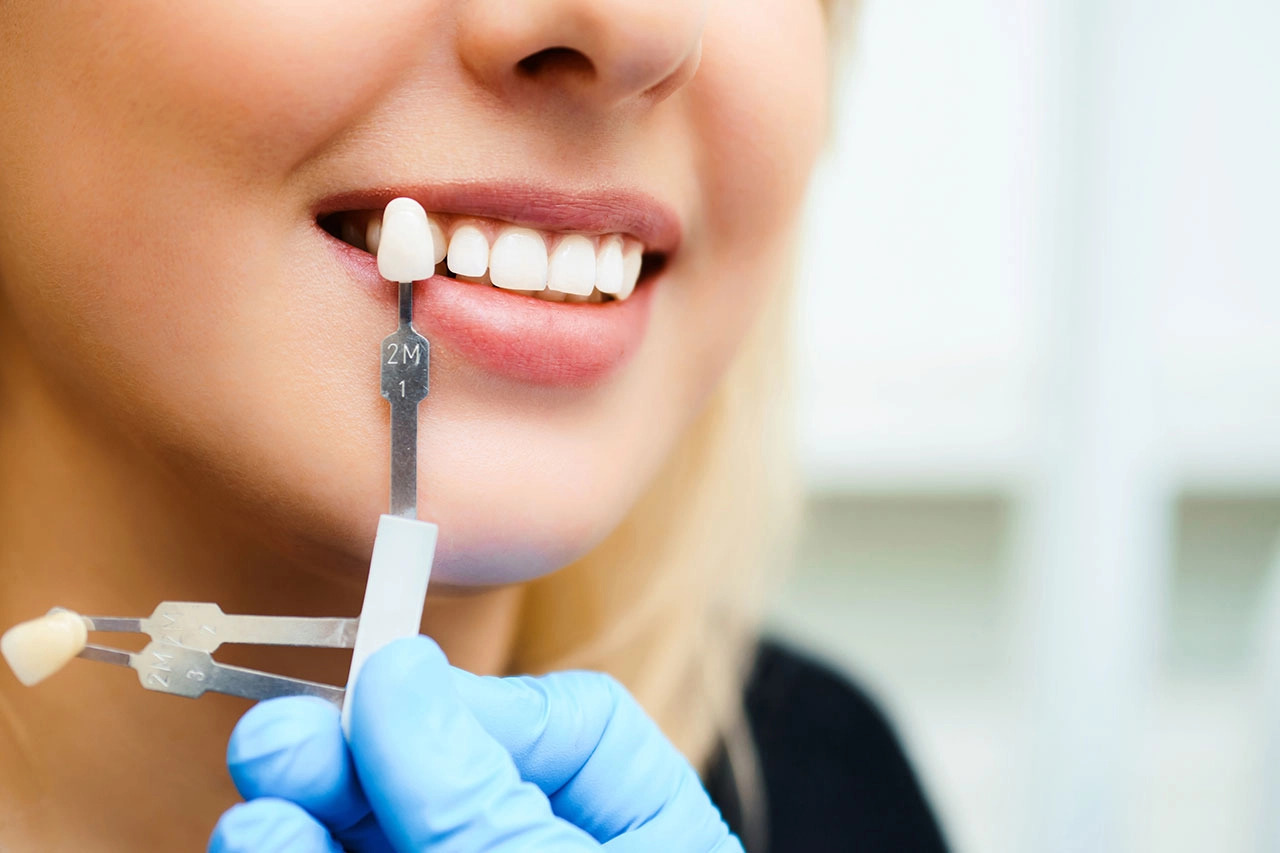 Dental Crowns Crystal City