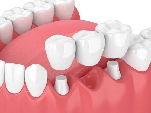 Dental Implants Arlington VA, Dental Implants Alexandria