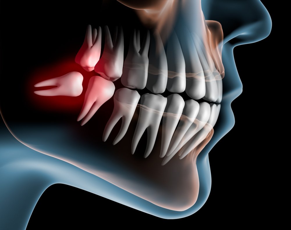 Wisdom Teeth Removal is something people prefer after facing difficulties