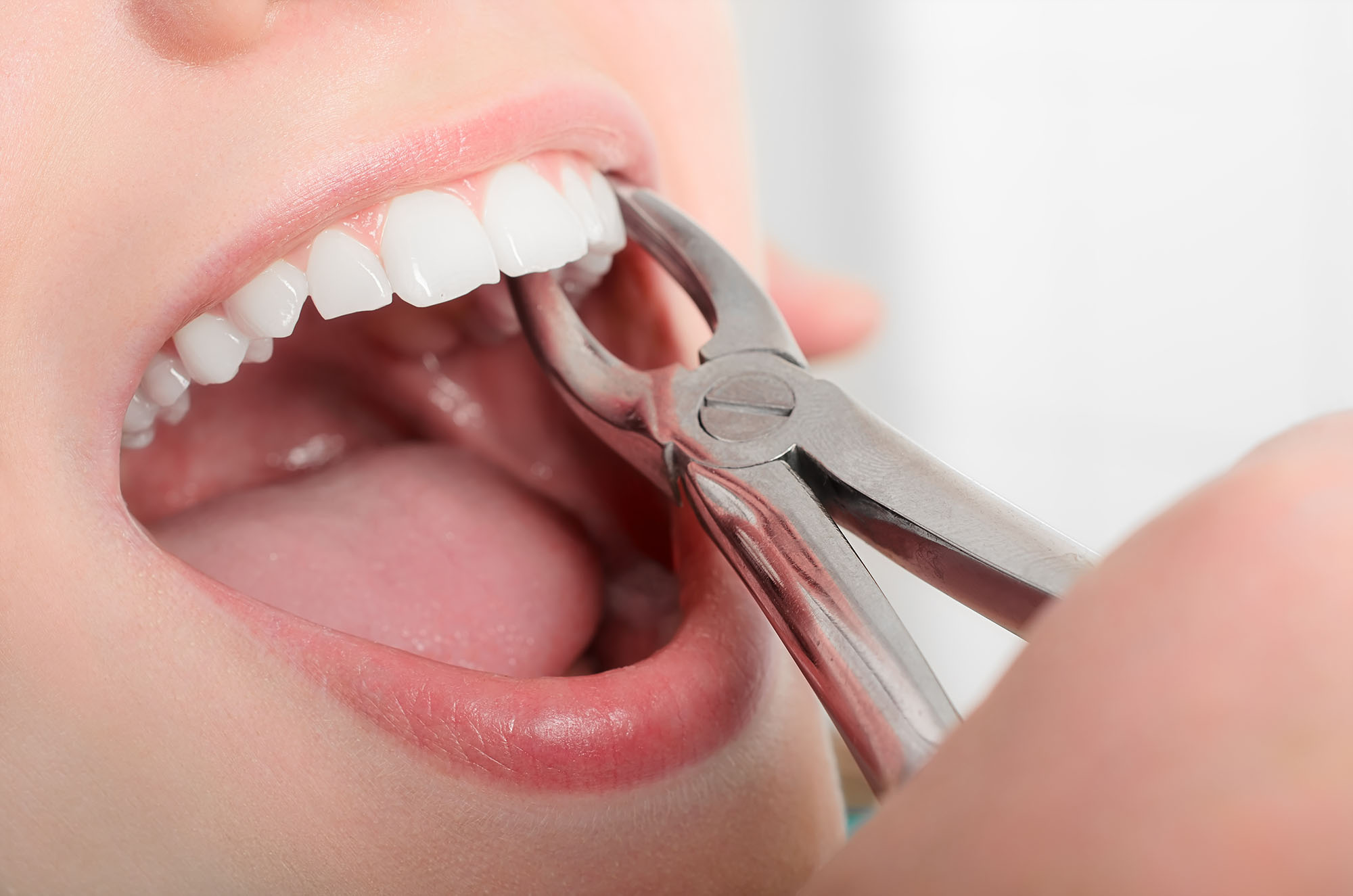 Wisdom teeth removal Arlington VA, Dental Office in Arlington VA