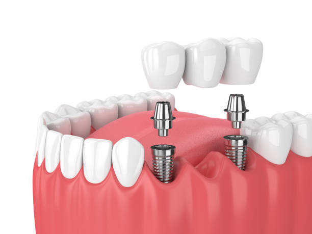 Dental Implants Alexandria