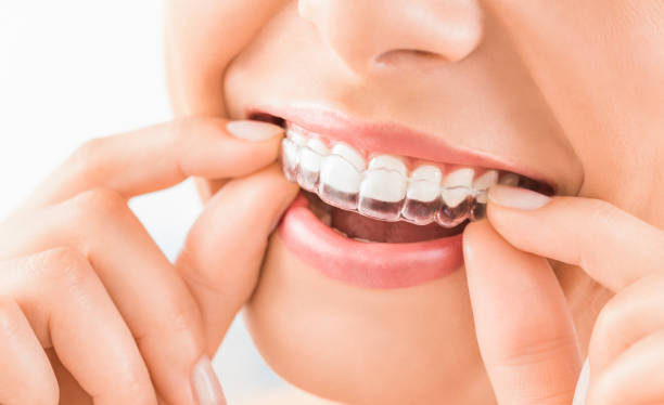 Invisalign Braces Arlington VA