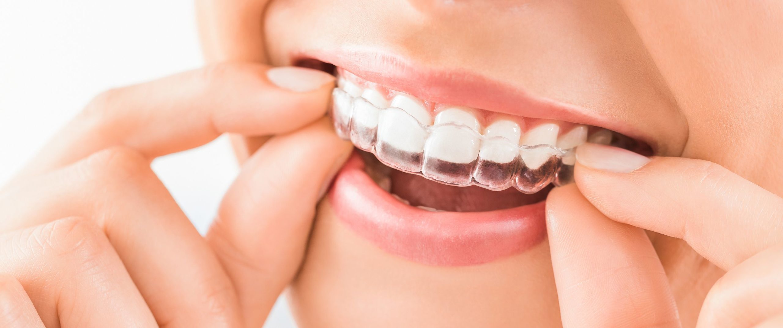 Invisalign Braces Arlington feature img