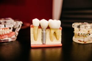 Dental Implants in Alexandria