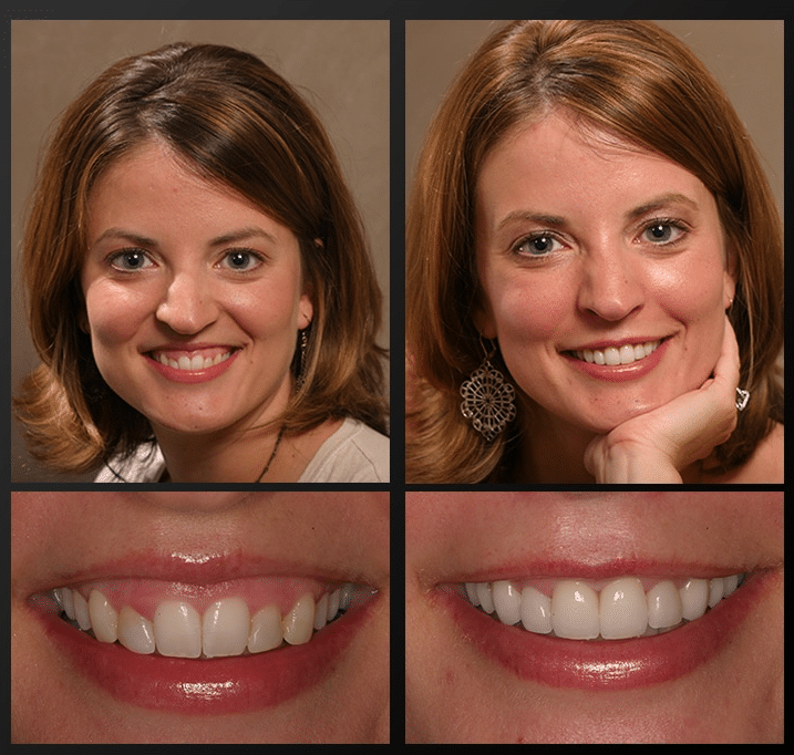 Gum Contouring in Arlington VA Before & After