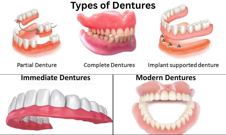 types of dentures arlington