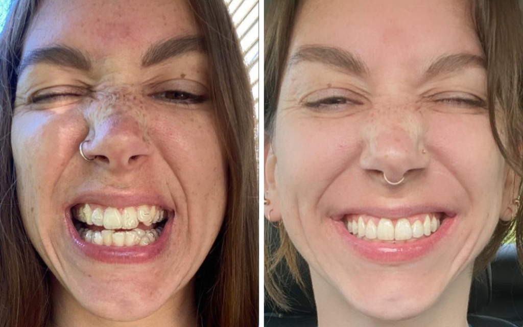 Invisalign before and after pictures: Smiling patient with teeth straightened using Invisible braces, showing best results achieved through a custom treatment plan and orthodontics in Arlington.