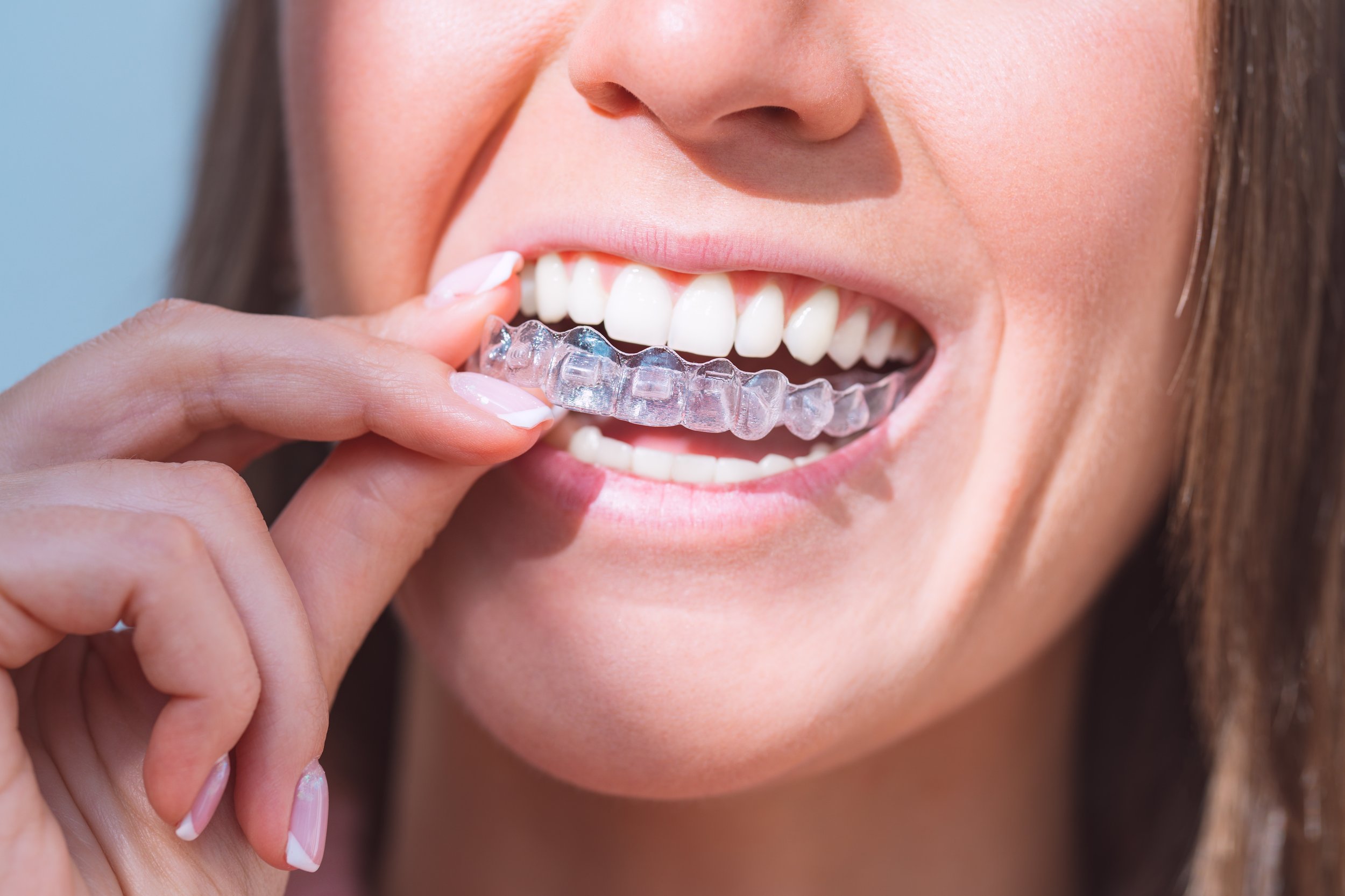 invisalign+tx invisalign+tx