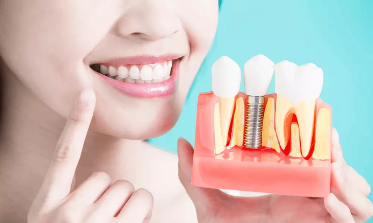 Dental Implants Arlington VA