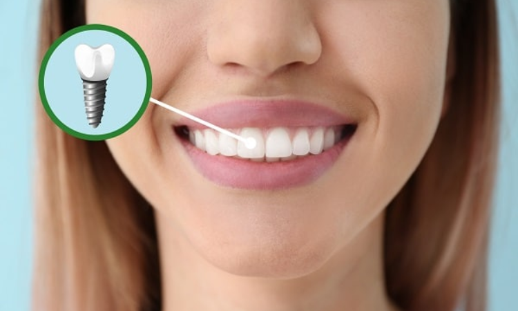 Dental Implants Arlington VA
