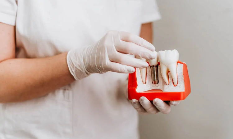 Dental Implants Arlington VA