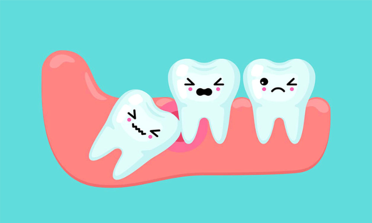 Wisdom Teeth Removal Arlington VA