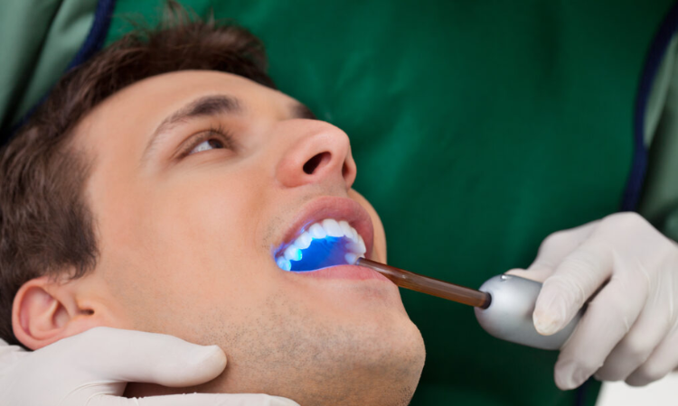 Lumineers Dental Cost Arlington