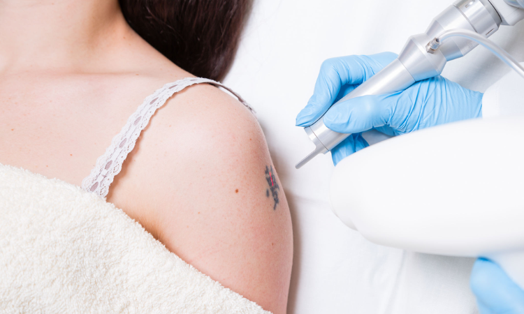 Tattoo Removal Treatment in Arlington
