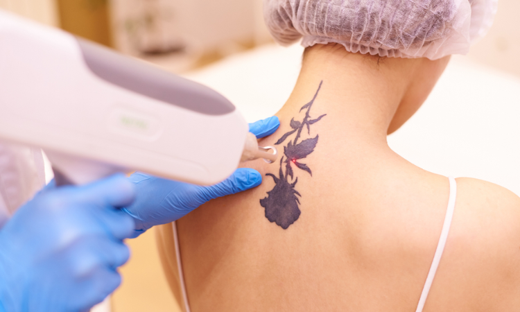 Tattoo Removal Treatment in Arlington
