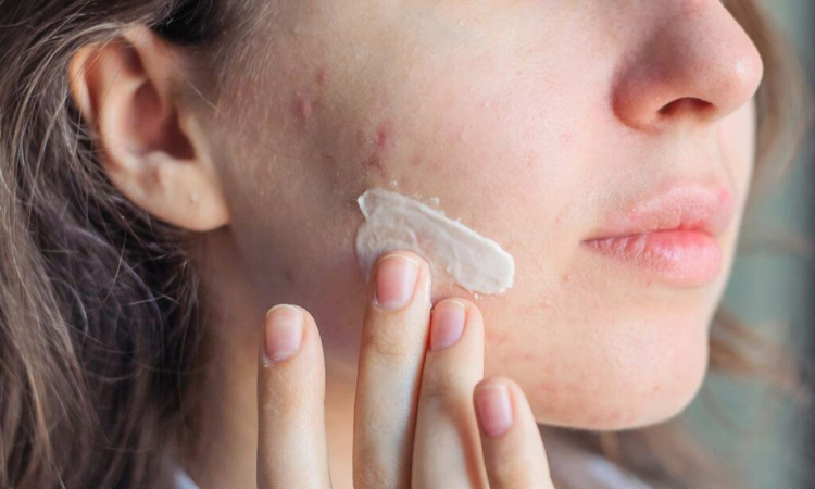 Acne Treatment in Arlington
