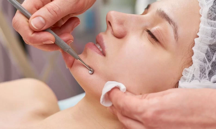 Acne Treatment in Arlington