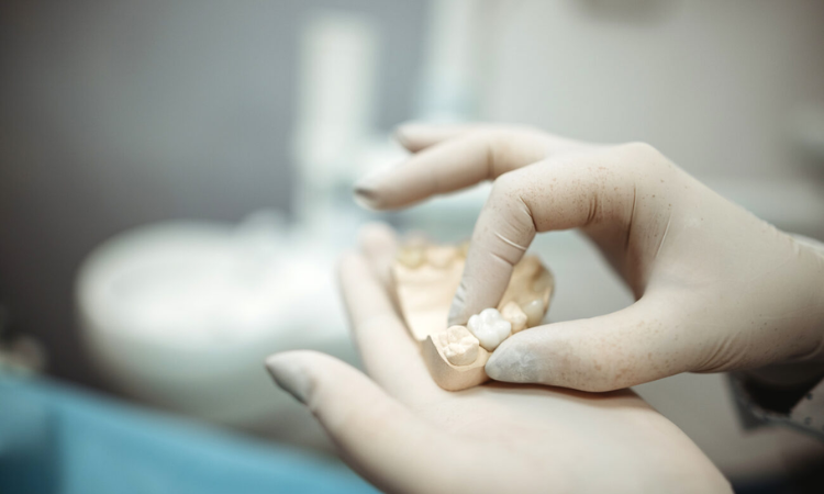 Dental Crowns Arlington