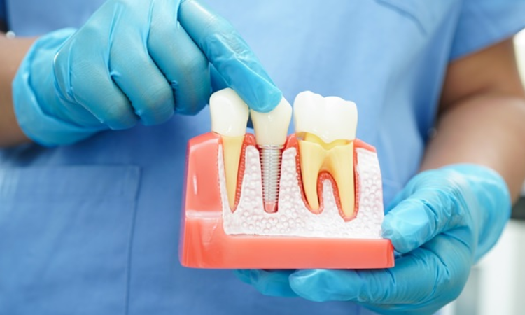 Dental Implants Arlington