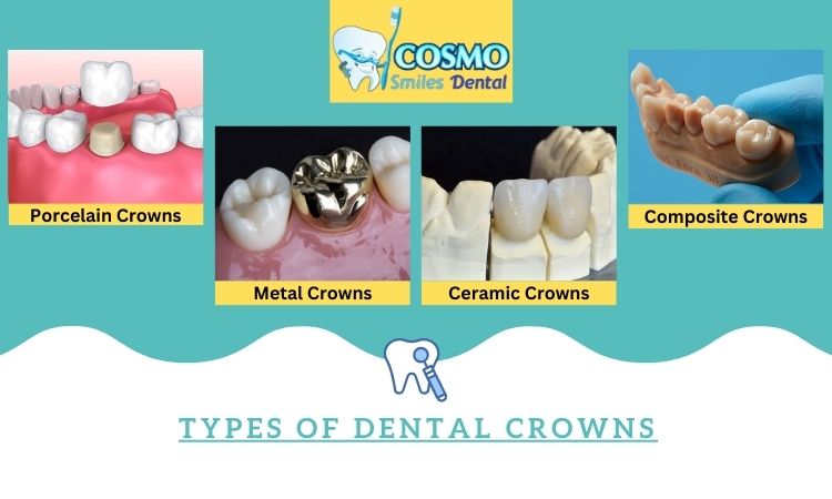 dental crowns in Arlington dental crowns in Arlington