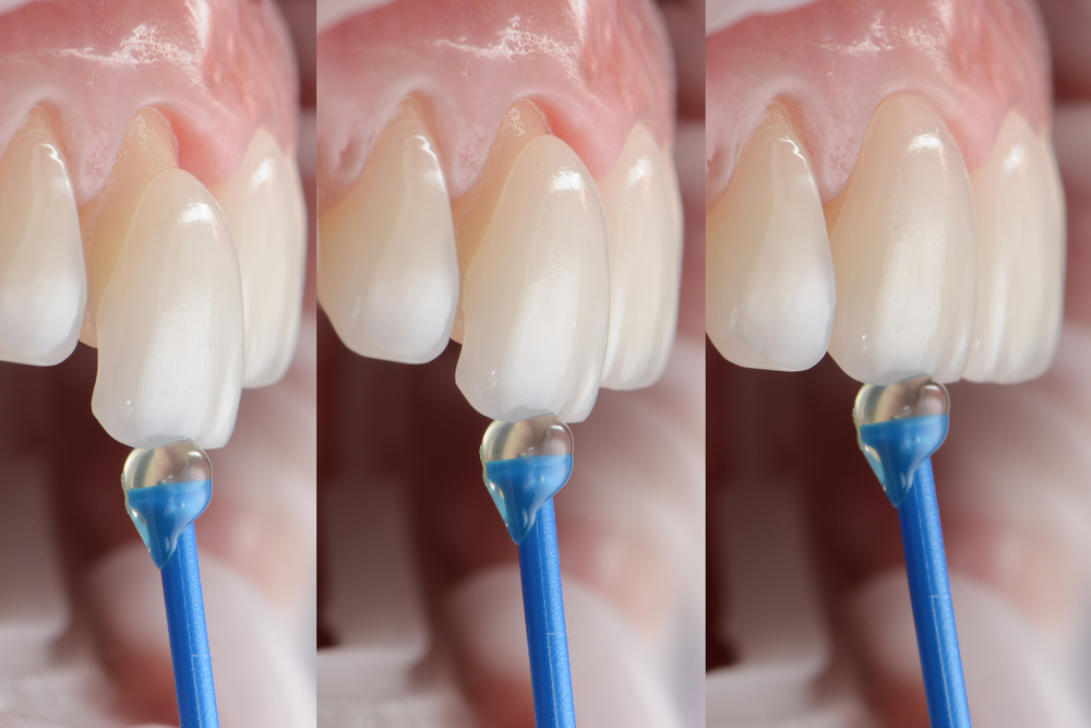 Custom Dental Veneers in Crystal City Custom Dental Veneers in Crystal City
