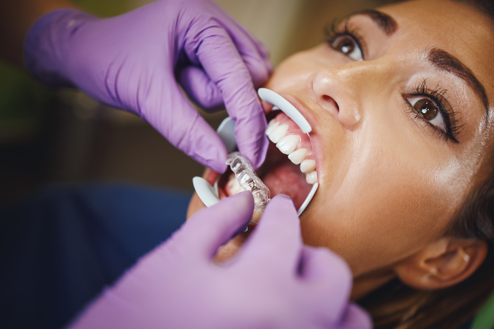 Invisalign Braces in Arlington VA Invisalign Braces in Arlington VA
